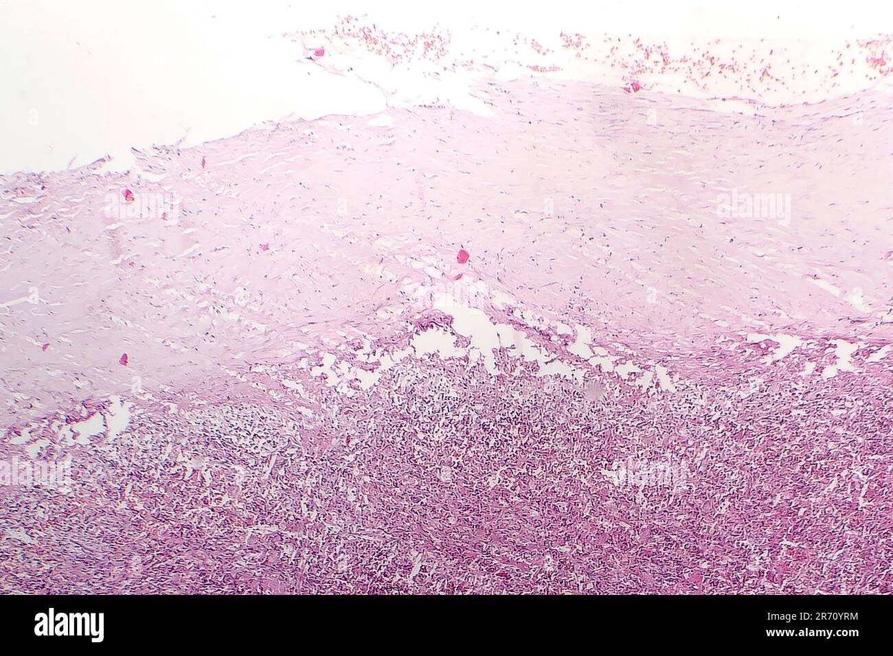 Milzkapsel hyaline Degeneration, Lichtmikroskopie, Foto unter dem Mikroskop Stockfoto
