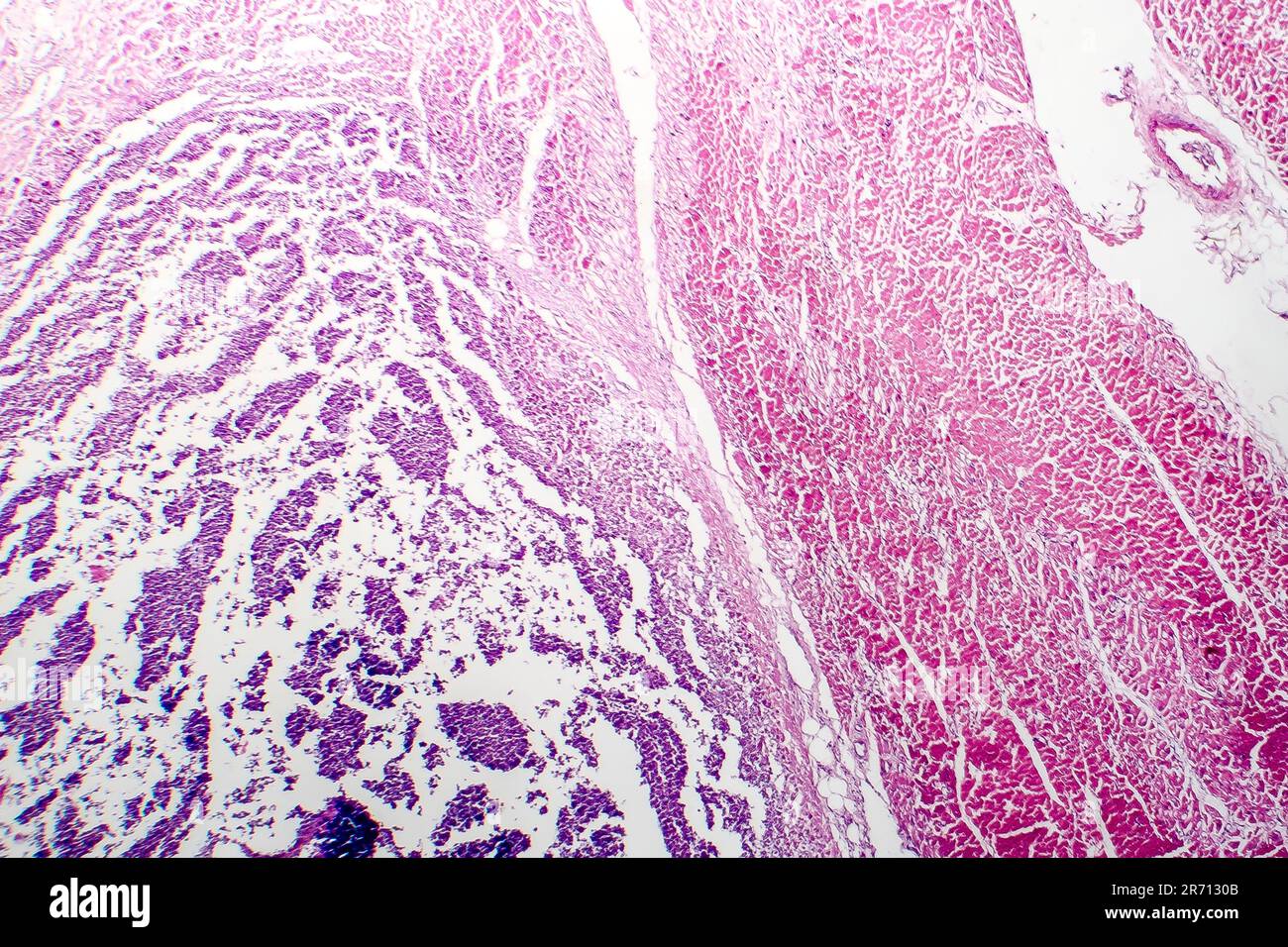 Histopathologie der bakteriellen Myokarditis, entzündlichen Herzkrankheit, Lichtmikrographen Stockfoto