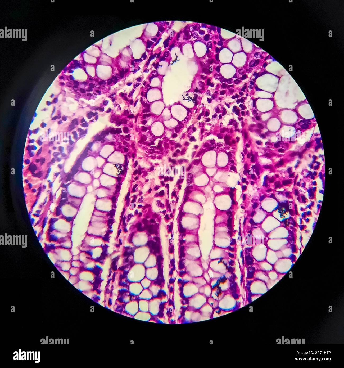 Bakterielle Dysenterie, Lichtmikroskopie, Foto unter dem Mikroskop, das das Vorhandensein von Bakterien und die Ansammlung von Entzündungszellen im Darmepithe zeigt Stockfoto
