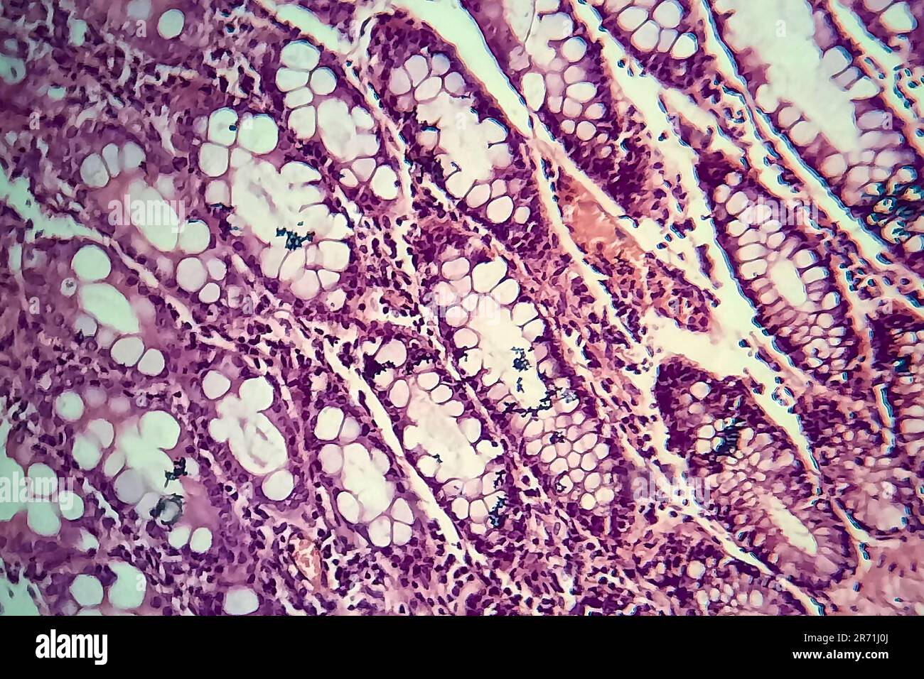 Bakterielle Dysenterie, Lichtmikroskopie, Foto unter dem Mikroskop, das das Vorhandensein von Bakterien und die Ansammlung von Entzündungszellen im Darmepithe zeigt Stockfoto