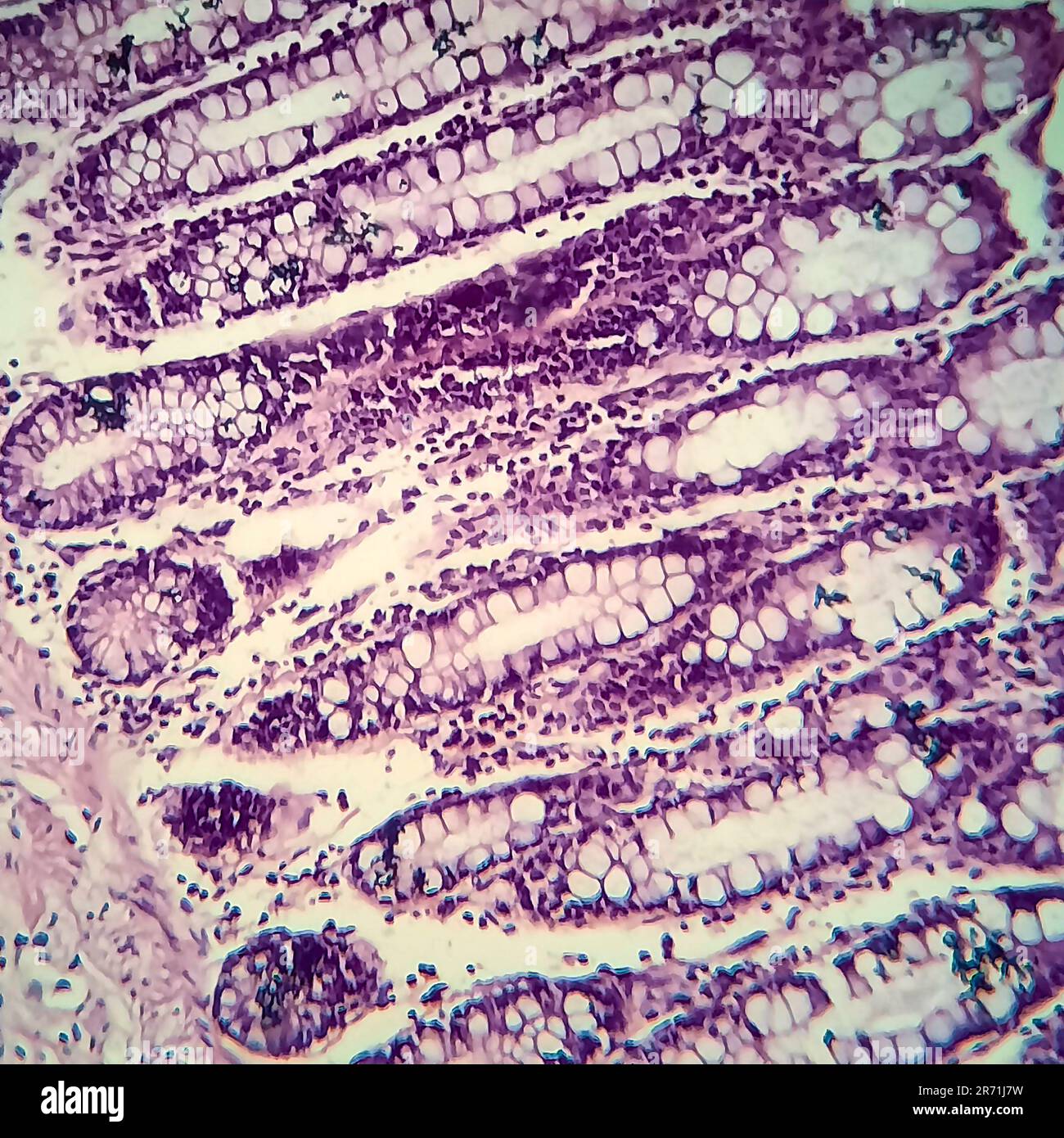 Bakterielle Dysenterie, Lichtmikroskopie, Foto unter dem Mikroskop, das das Vorhandensein von Bakterien und die Ansammlung von Entzündungszellen im Darmepithe zeigt Stockfoto