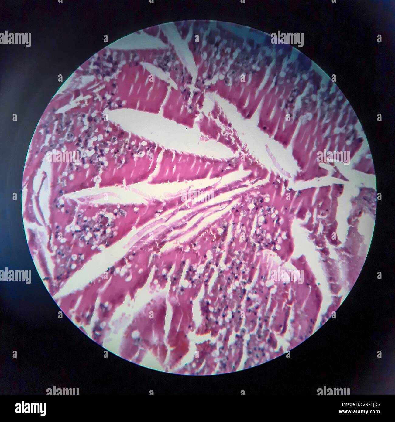 Schilddrüsenfollikelkarzinom, Lichtmikroskopie, Foto unter dem Mikroskop Stockfoto