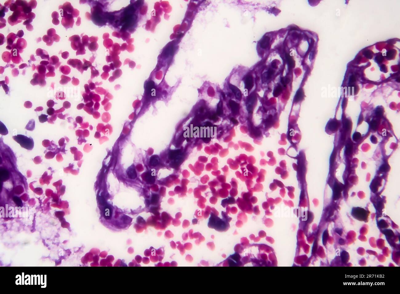 Histopathologie der Raucherlunge. Lichtmikrographie zeigt Akkumulation von Kohlenstoffpartikeln im Lungengewebe Stockfoto