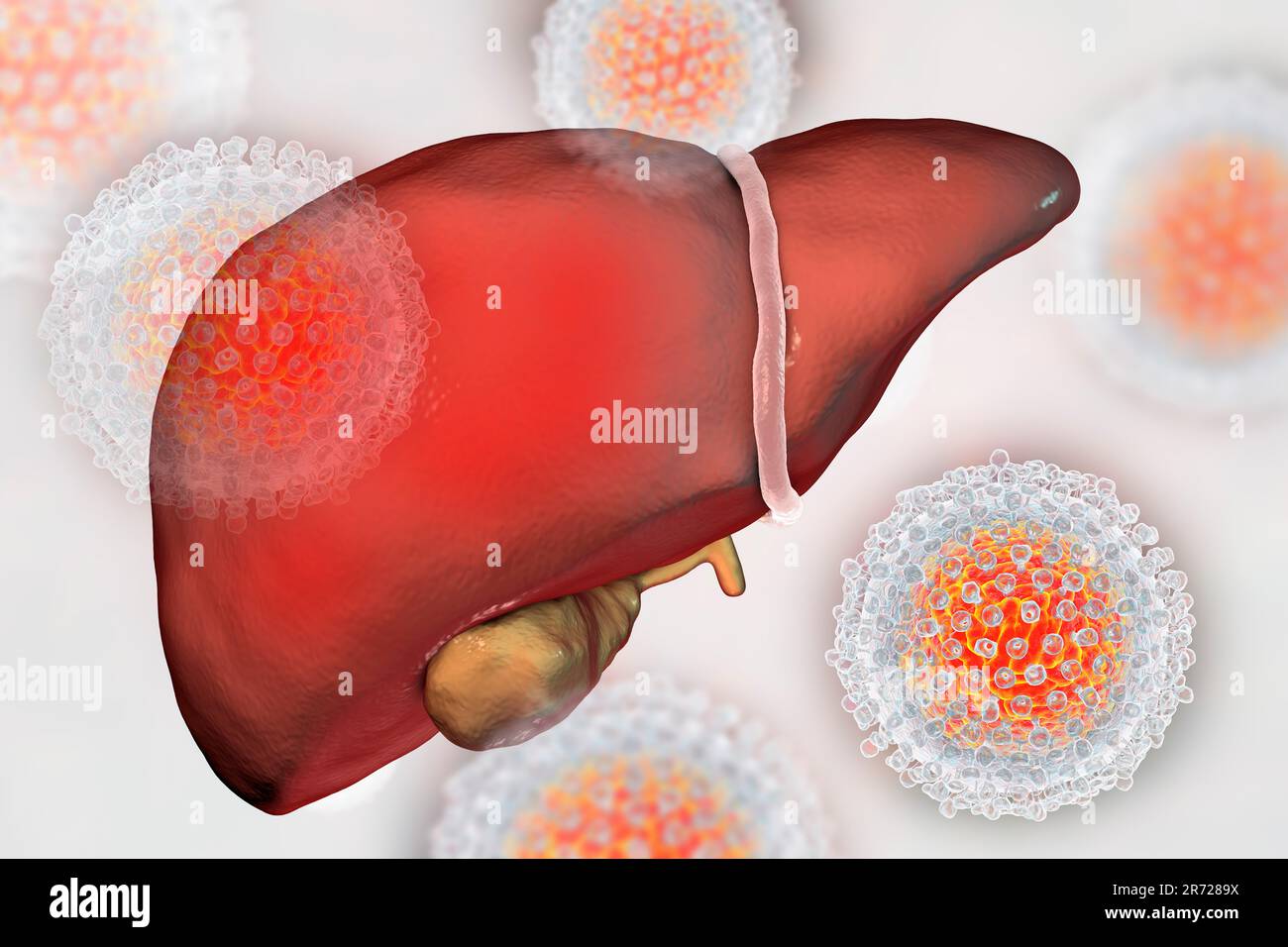 Leber mit Hepatitis und Nahaufnahme Blick auf Hepatitis C-Viren, Abbildung. Stockfoto