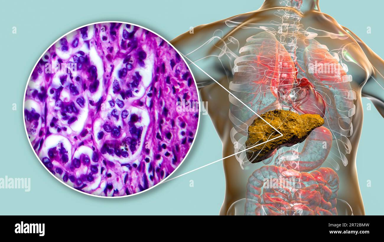 Leberzirrhose, Computerdarstellung und Lichtmikroskopie eines Schnitts durch eine menschliche Leber mit Stockfoto