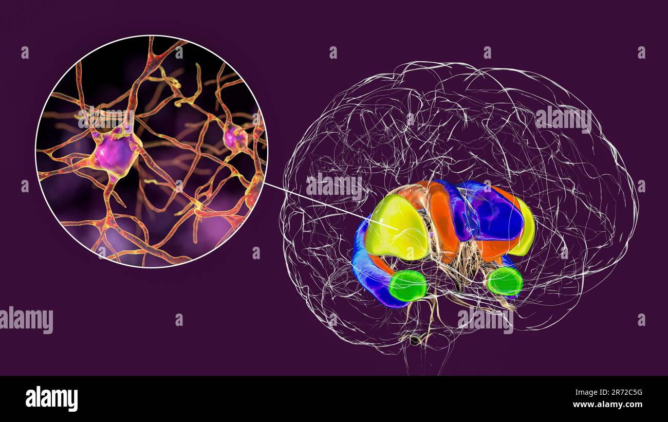 Dorsales Striatum hervorgehoben im Gehirn und seinen Neuronen, Computerdarstellung. Das dorsale Striatum besteht aus dem Nucleus caudatus (orange) und der Pute Stockfoto