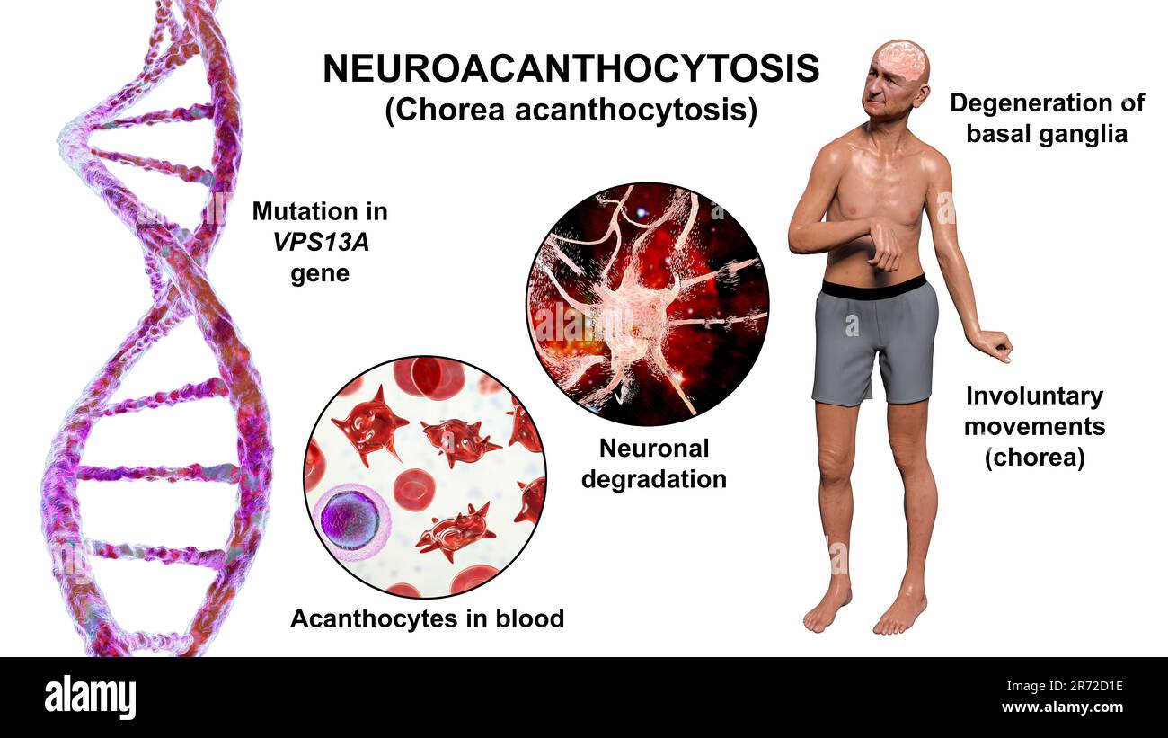 Neuroacanthozytose, Chorea acanthocytosis, eine neurodegenerative Erkrankung aufgrund einer Mutation im Gen VPS13A, ist sie durch das Vorhandensein von Acanthozyten i gekennzeichnet Stockfoto