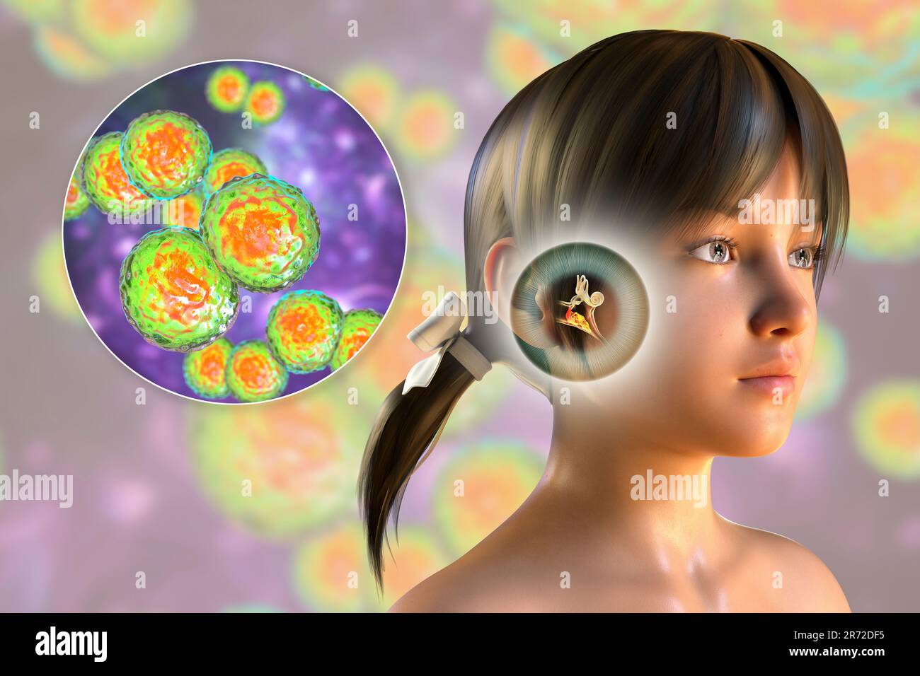Otitis media-Ohrinfektion durch Streptococcus pyogenes-Bakterien, konzeptionelle Computerdarstellung. Akute Otitis media ist die Entzündung des Stockfoto