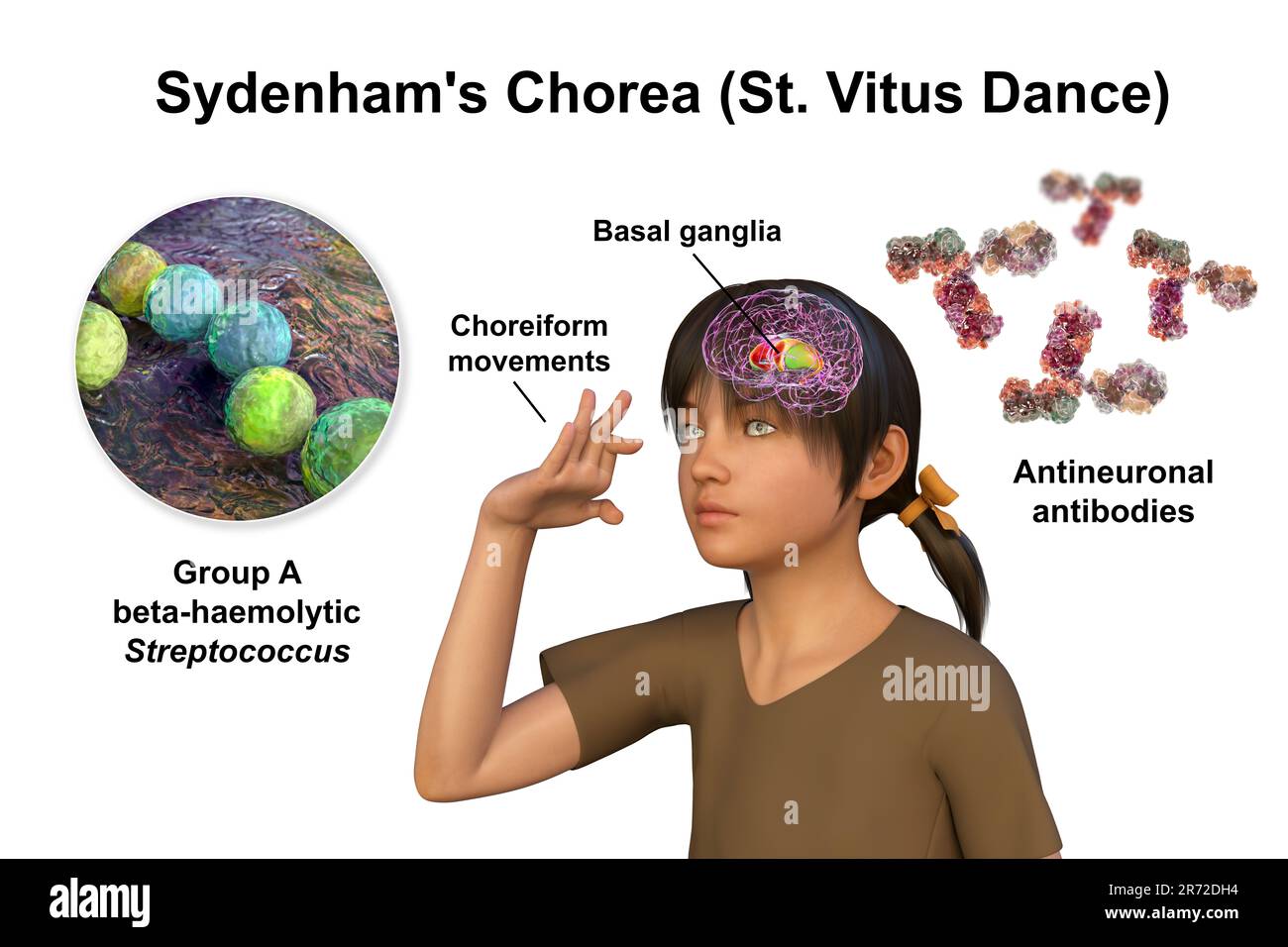 Chorea Sydenham, eine Autoimmunerkrankung, die aus einer Streptokokkeninfektion resultiert, Bildung von anti-neuronalen Antikörpern, die die Basalganglien des Gehirns schädigen Stockfoto