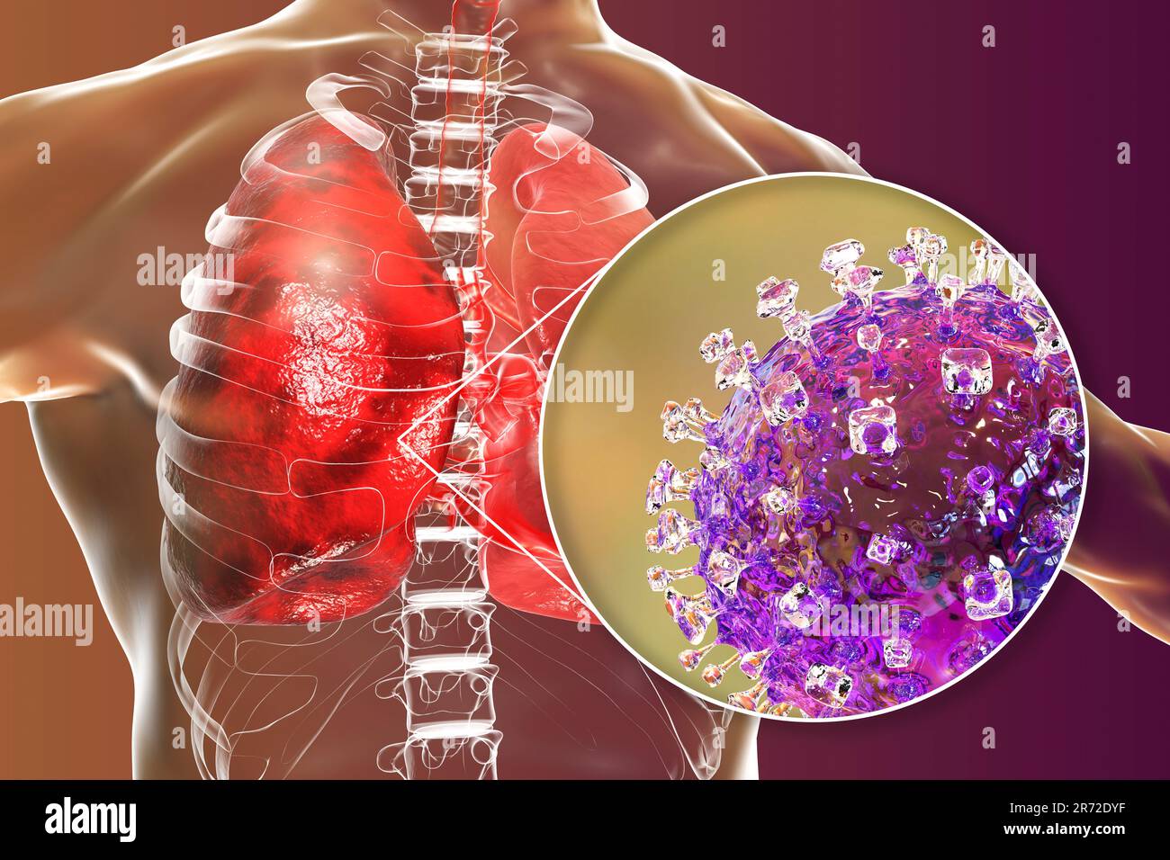 Nipah-Virus in der Lunge, konzeptuelle Computerdarstellung. Das Nipah-Virus ist zoonotisch (von Tieren auf den Menschen übertragen) und wurde erstmals in Malaysia A gefunden Stockfoto