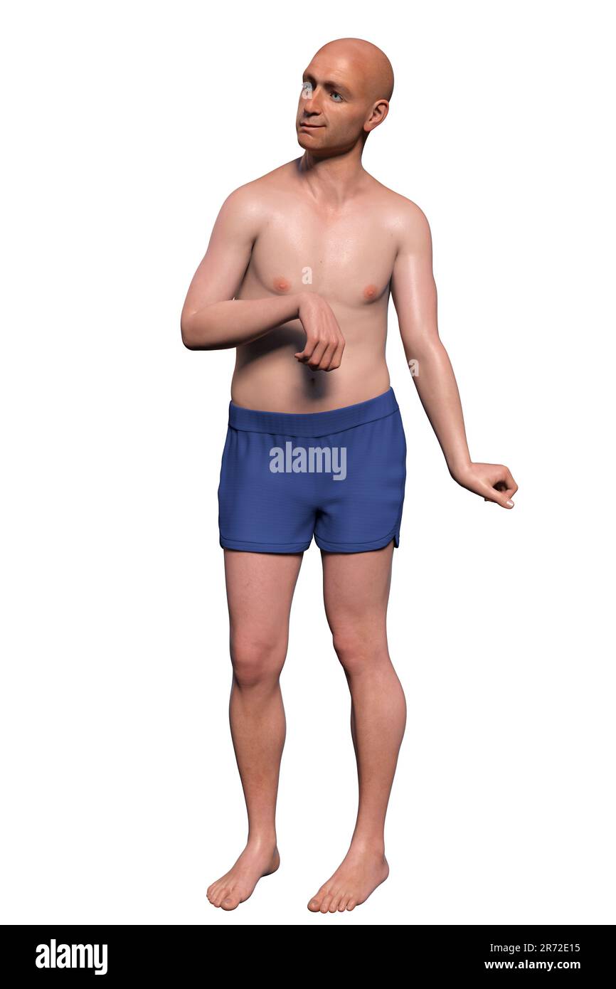 Eine Person mit Chorea Huntington, einer neurodegenerativen Erkrankung aufgrund einer Mutation im HTT-Gen, Veränderungen in den Basalganglien des Gehirns, die zu einer zufälligen Uncon führen Stockfoto