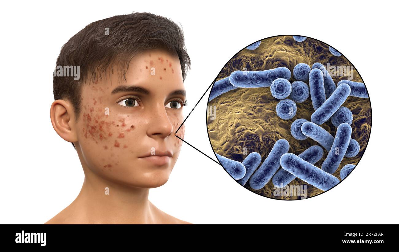 Akne vulgaris im Gesicht eines Teenagers und Nahaufnahme von Bakterien, die Akne verursachen, Computerdarstellung. Akne ist ein allgemeiner Name für eine Haut Stockfoto