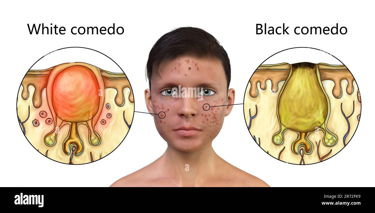 Akne vulgaris im Gesicht eines Teenagers und Nahaufnahme von schwarz-weißen Komedonen, Computerdarstellung. Akne ist ein allgemeiner Name, der einem Haut-di gegeben wird Stockfoto