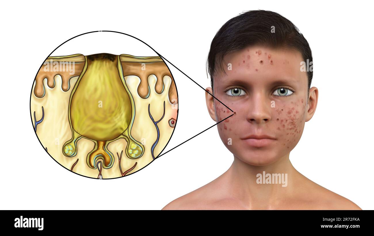 Akne vulgaris im Gesicht eines Teenagers und Nahaufnahme des schwarzen Comedo, Computerabbildung. Akne ist ein allgemeiner Name für eine Hauterkrankung in Stockfoto