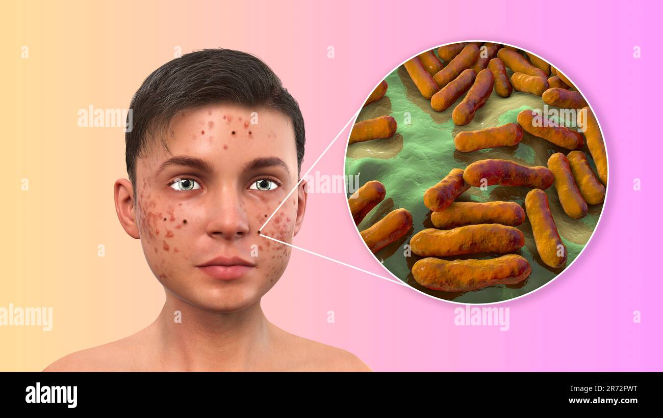 Akne vulgaris im Gesicht eines Teenagers und Nahaufnahme von Bakterien, die Akne verursachen, Computerdarstellung. Akne ist ein allgemeiner Name für eine Haut Stockfoto