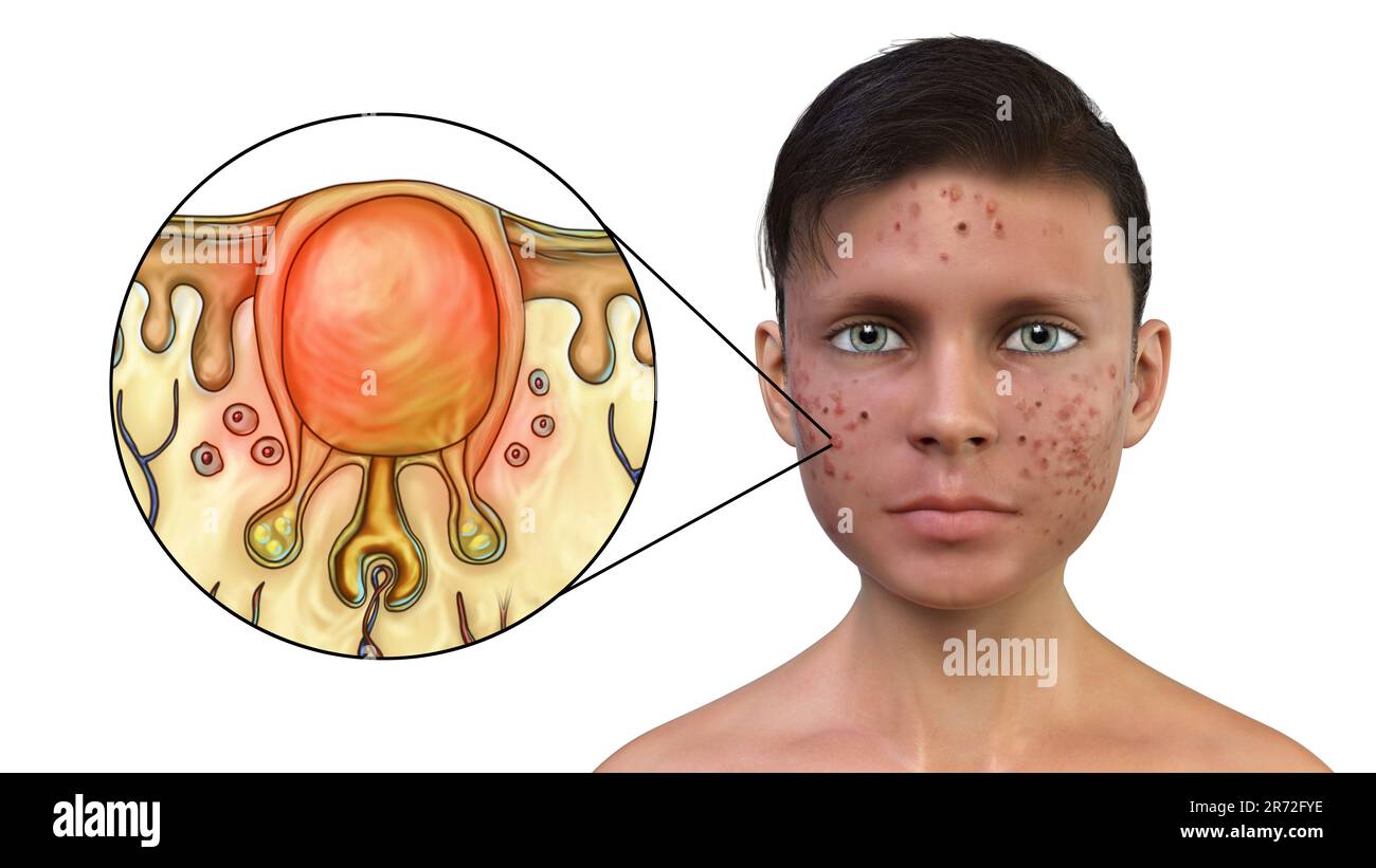 Akne vulgaris im Gesicht eines Teenagers und Nahaufnahme von schwarz-weißen Komedonen, Computerdarstellung. Akne ist ein allgemeiner Name, der einem Haut-di gegeben wird Stockfoto