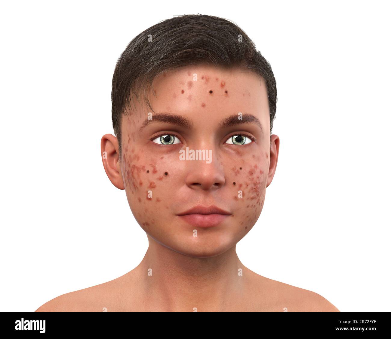Akne vulgaris im Gesicht eines Teenagers, Computerabbildung. Akne ist ein allgemeiner Name für eine Hauterkrankung, bei der die Talgdrüsen inf werden Stockfoto
