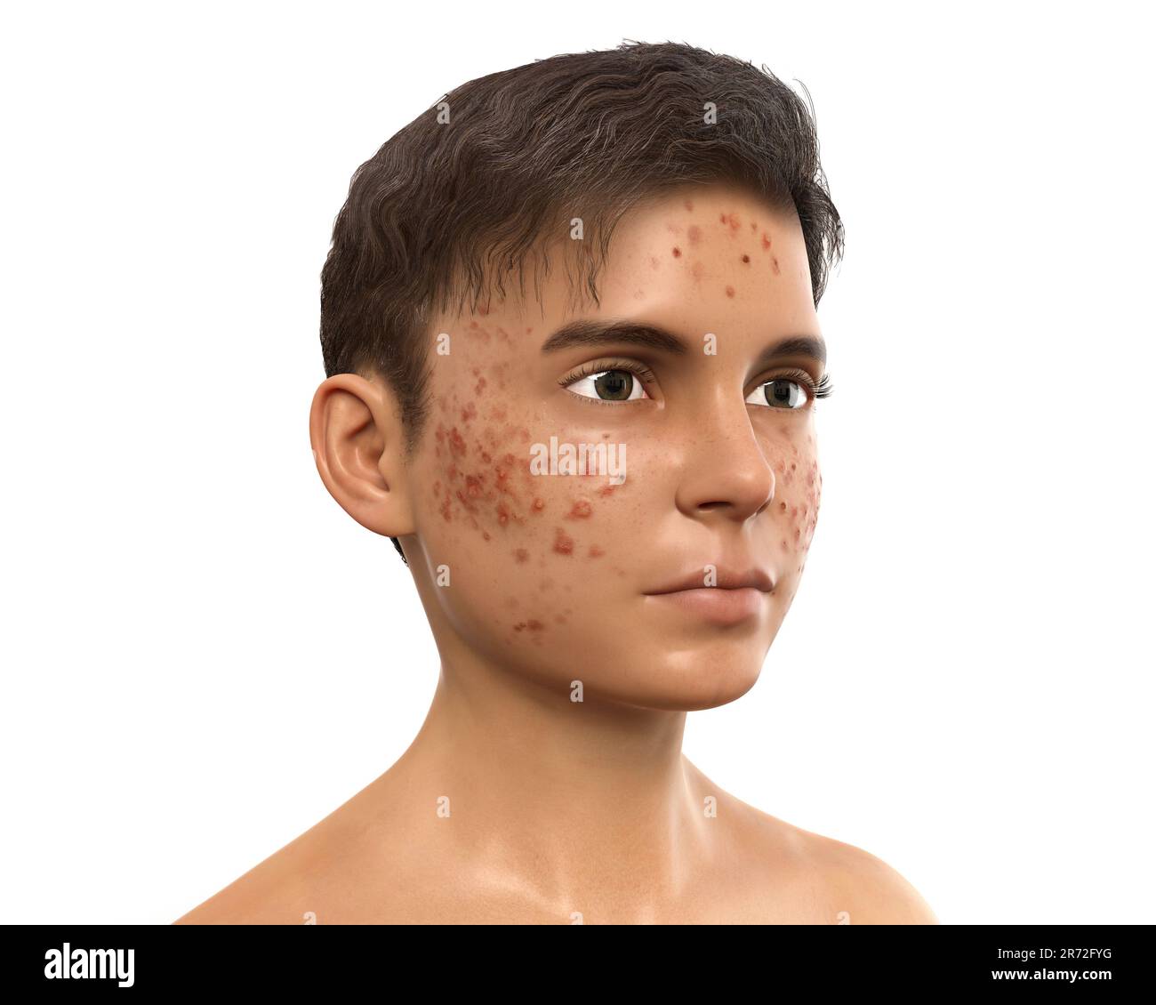 Akne vulgaris im Gesicht eines Teenagers, Computerabbildung. Akne ist ein allgemeiner Name für eine Hauterkrankung, bei der die Talgdrüsen inf werden Stockfoto