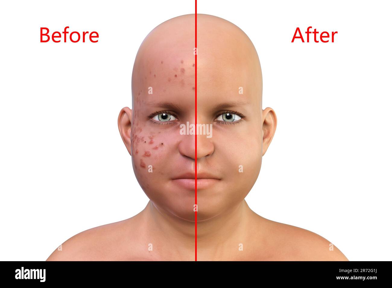 Akne vulgaris im Gesicht eines übergewichtigen Jungen, Computerdarstellung der Haut des Jungen vor und nach der Behandlung. Akne ist ein allgemeiner Name giv Stockfoto