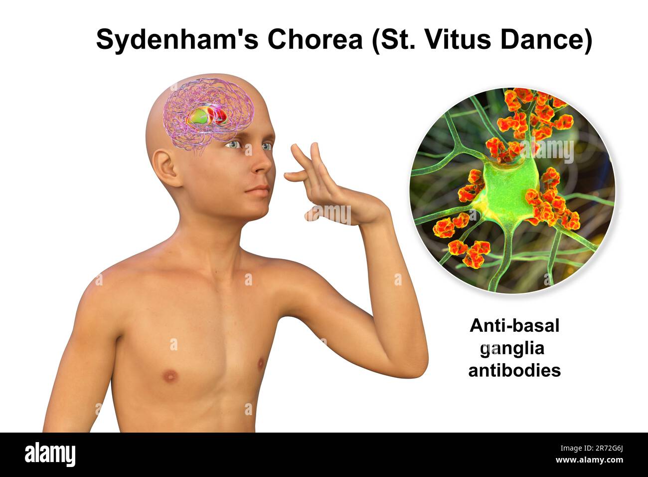 Chorea Sydenham, eine Autoimmunerkrankung, die aus einer Streptokokkeninfektion resultiert, Bildung von anti-neuronalen Antikörpern, die die Basalganglien des Gehirns schädigen Stockfoto