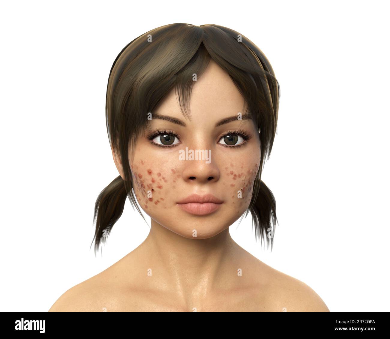 Akne vulgaris im Gesicht eines Teenagers, Computerabbildung. Akne ist ein allgemeiner Name für eine Hauterkrankung, bei der die Talgdrüsen eindringen Stockfoto