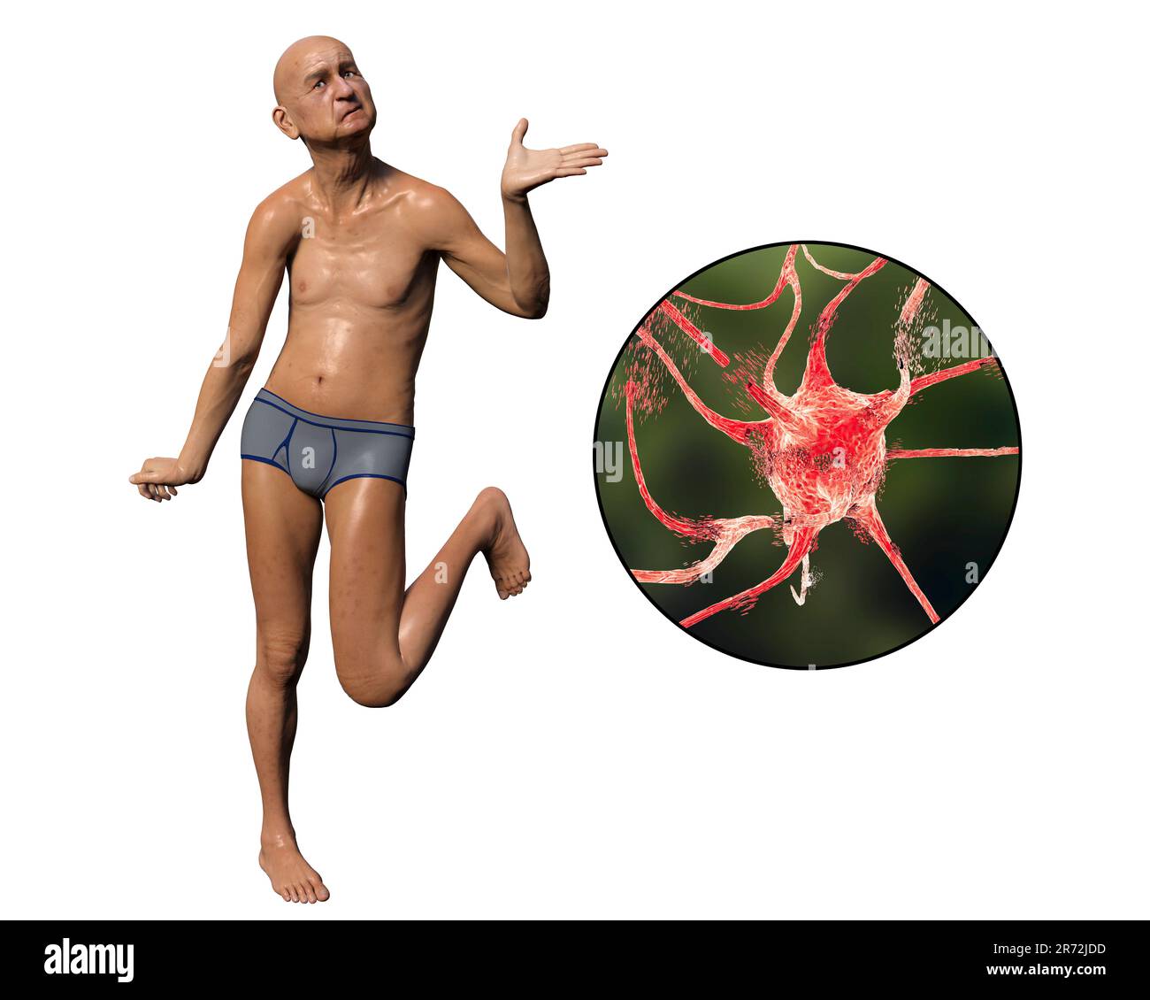 Eine Person mit Chorea-Krankheit und Nahaufnahme des neuronalen Abbaus, der durch choreiforme Bewegungen entsteht, konzeptionelle Computerdarstellung. Stockfoto