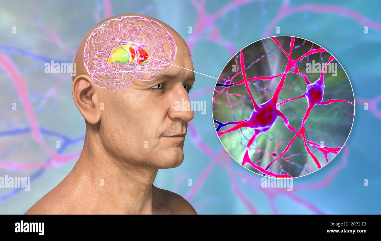 Dorsales Striatum hervorgehoben im menschlichen Gehirn und Nahaufnahme seiner Neuronen, Computerdarstellung. Es ist ein Kern in den Basalganglien, eine Komponente Stockfoto