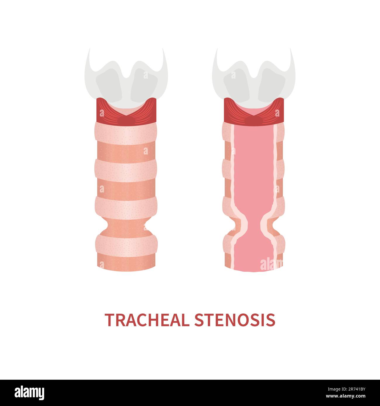 Trachea-verengende Wahrnehmungssymbole der Trachealstenose Stock Vektor