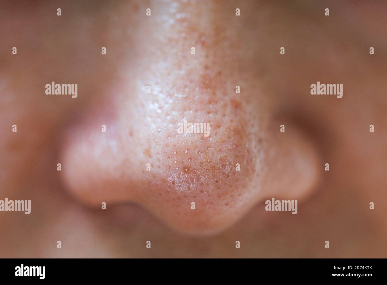 Pickel auf der nase Fotos und Bildmaterial in hoher Auflösung Alamy