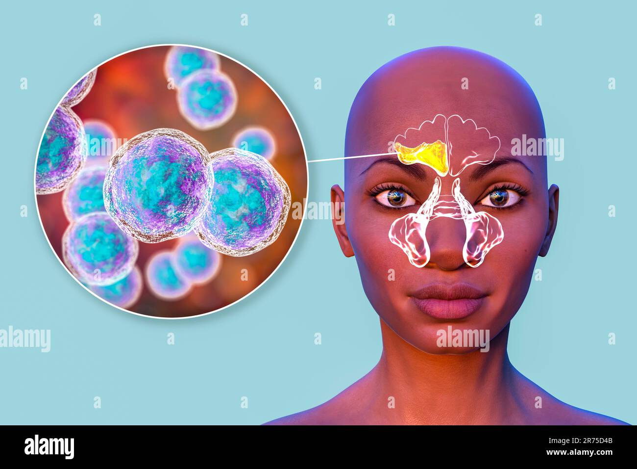 Moraxella-catarrhalis-Bakterien als Ursache einer Sinusitis. Computerdarstellung der Stirnhöhlenentzündung und Nahaufnahme von Moraxella Bac Stockfoto