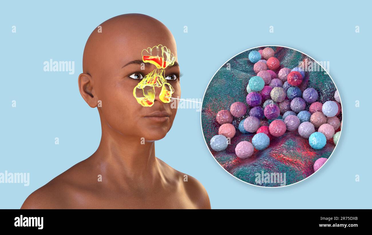 Staphylococcus aureusBakterien als Ursache einer Sinusitis