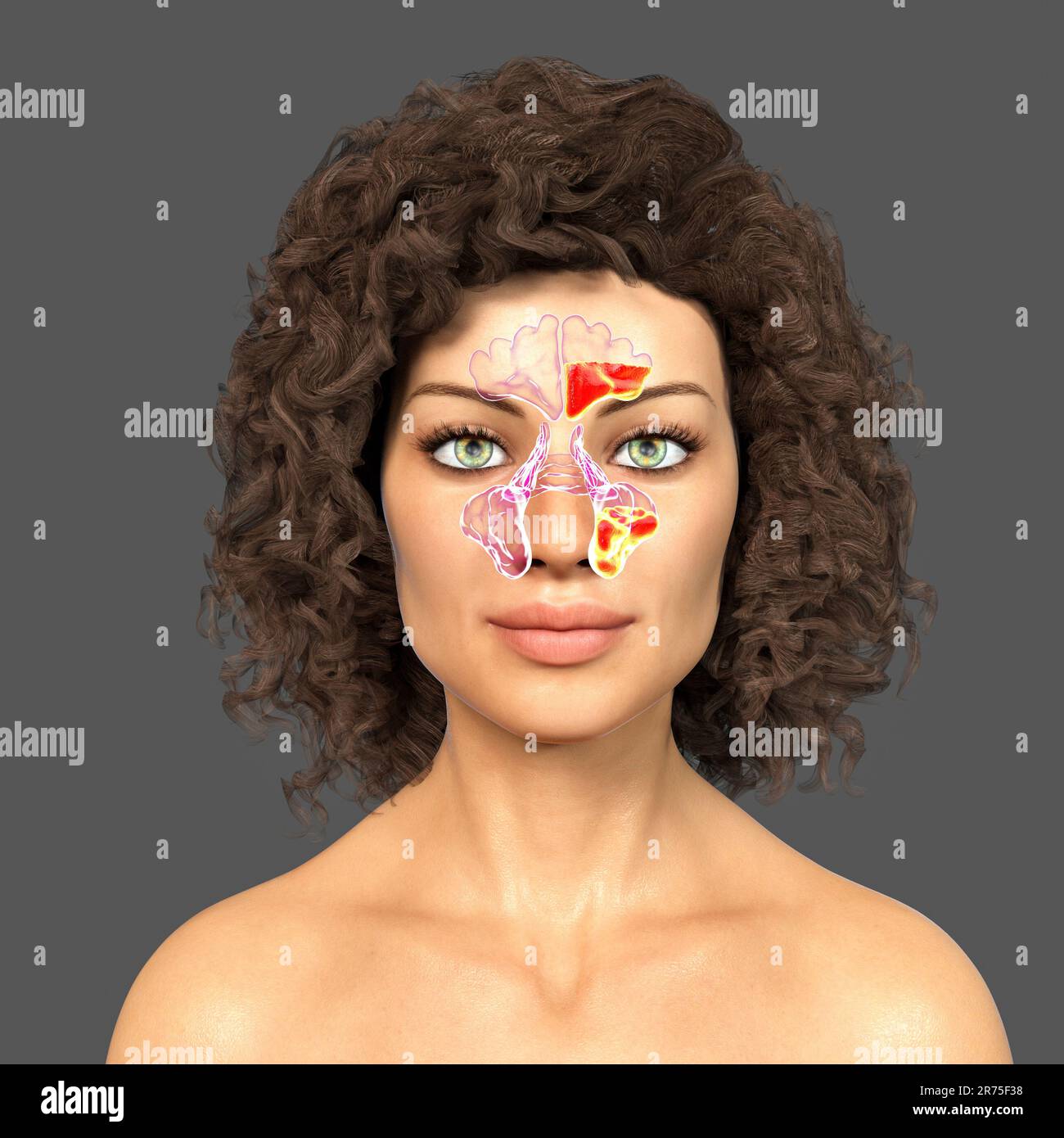 Nasennebenhöhlenentzündung oder Sinusitis, Computerdarstellung. Die Nebenhöhlen sind membranausgekleidete, luftgefüllte Räume in den Gesichtsknochen. Die Stirnhöhlen A. Stockfoto