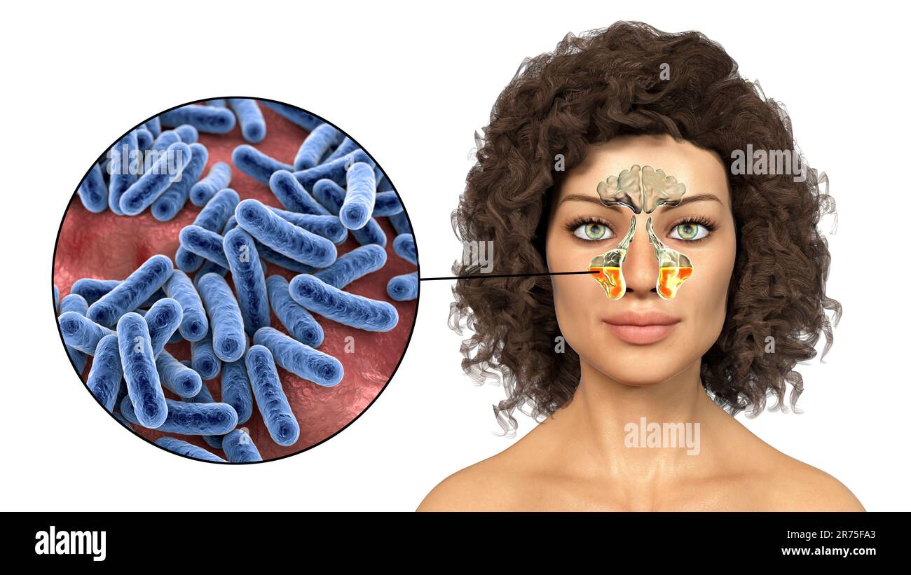 Sinusitis, Entzündung der Nasennebenhöhlen. Computerdarstellung einer eitrigen Entzündung der Kieferhöhlen bei einer Frau und Nahaufnahme o Stockfoto