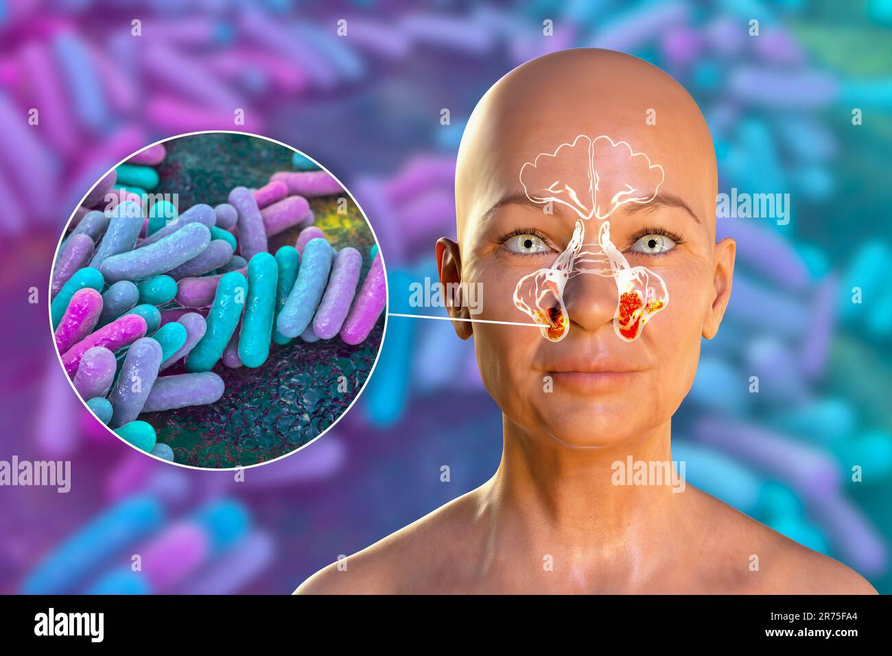 Bakterielle Sinusitis, Computerdarstellung. Die Nasennebenhöhlen sind membrangesäumte, luftgefüllte Räume in den Knochen des Gesichts. Die Stirnhöhlen liegen über t Stockfoto