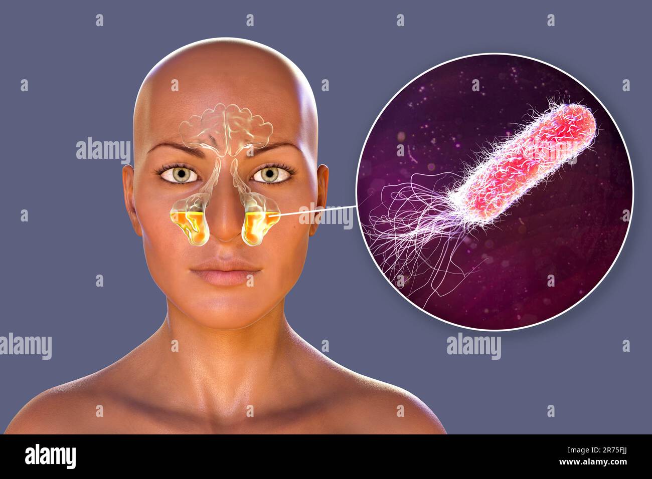 Pseudomonas aeruginosa-Bakterien als Ursache einer Sinusitis. Computerdarstellung der eitrigen Entzündung der Kieferhöhlen und Nahaufnahme Stockfoto