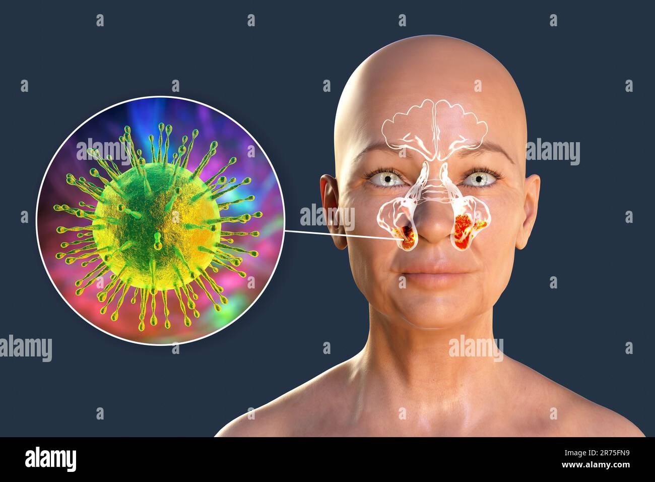 Virale Sinusitis, Computerdarstellung. Sinusitis, auch als Sinusinfektion oder Rhinosinusitis bezeichnet, ist eine Entzündung der Nasennebenhöhlen, die zu einem Symp führt Stockfoto
