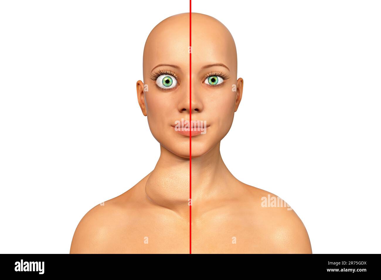 Thyreotoxische Struma (Struma), Illustration. Struma (geschwollener Hals) bei einer Patientin mit überaktiver Schilddrüse (links) im Vergleich Stockfoto