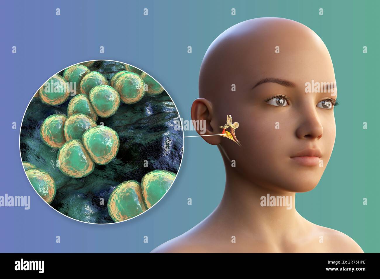 Otitis media-Ohrinfektion durch Streptococcus-pneumoniae-Bakterien, Computerdarstellung. Akute Otitis media ist die Entzündung des mittleren Meeres Stockfoto