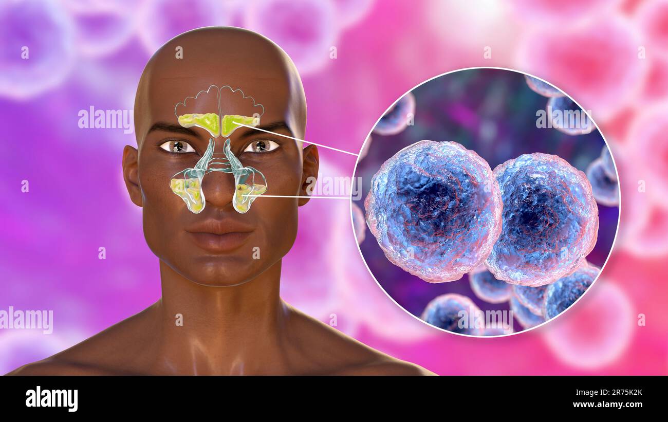 Bakterielle Sinusitis, Computerdarstellung. Die Nebenhöhlen sind membranausgekleidete, luftgefüllte Räume in den Gesichtsknochen. Sinusitis, auch Sinus genannt Stockfoto