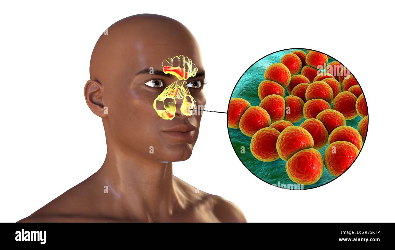 Bakterielle Sinusitis, Computerdarstellung. Die Nasennebenhöhlen sind membrangesäumte, luftgefüllte Räume in den Knochen des Gesichts. Die Stirnhöhlen liegen über t Stockfoto