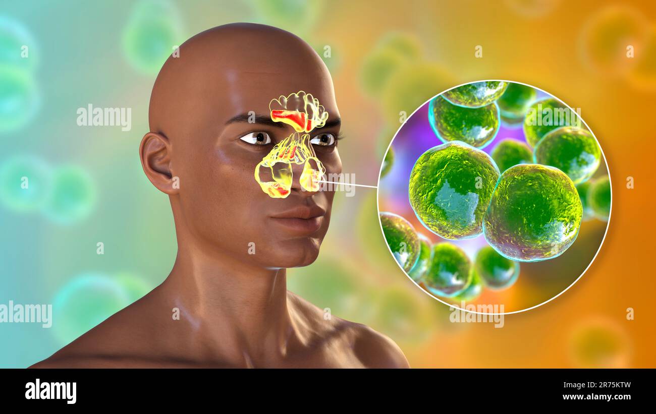 Bakterielle Sinusitis, Computerdarstellung. Die Nasennebenhöhlen sind membrangesäumte, luftgefüllte Räume in den Knochen des Gesichts. Die Stirnhöhlen liegen über t Stockfoto