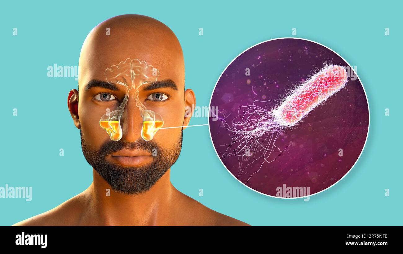 Pseudomonas aeruginosa-Bakterien als Ursache einer Sinusitis. Computerdarstellung der eitrigen Entzündung der Kieferhöhlen und Nahaufnahme Stockfoto