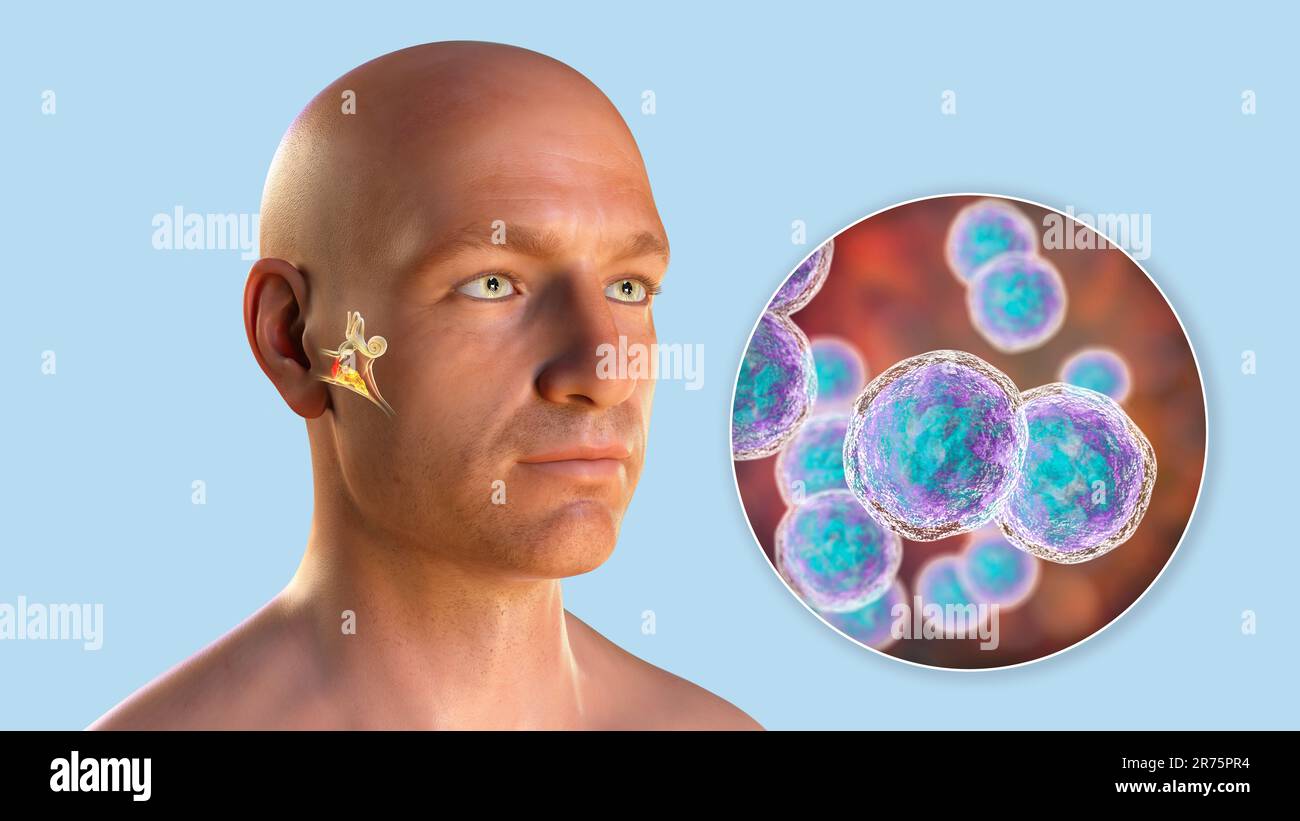 Otitis media Ohr Infektion durch Moraxella catarrhalis Bakterien verursacht, konzeptionelle Computer-Illustration. Akute Otitis media ist die Entzündung der m Stockfoto