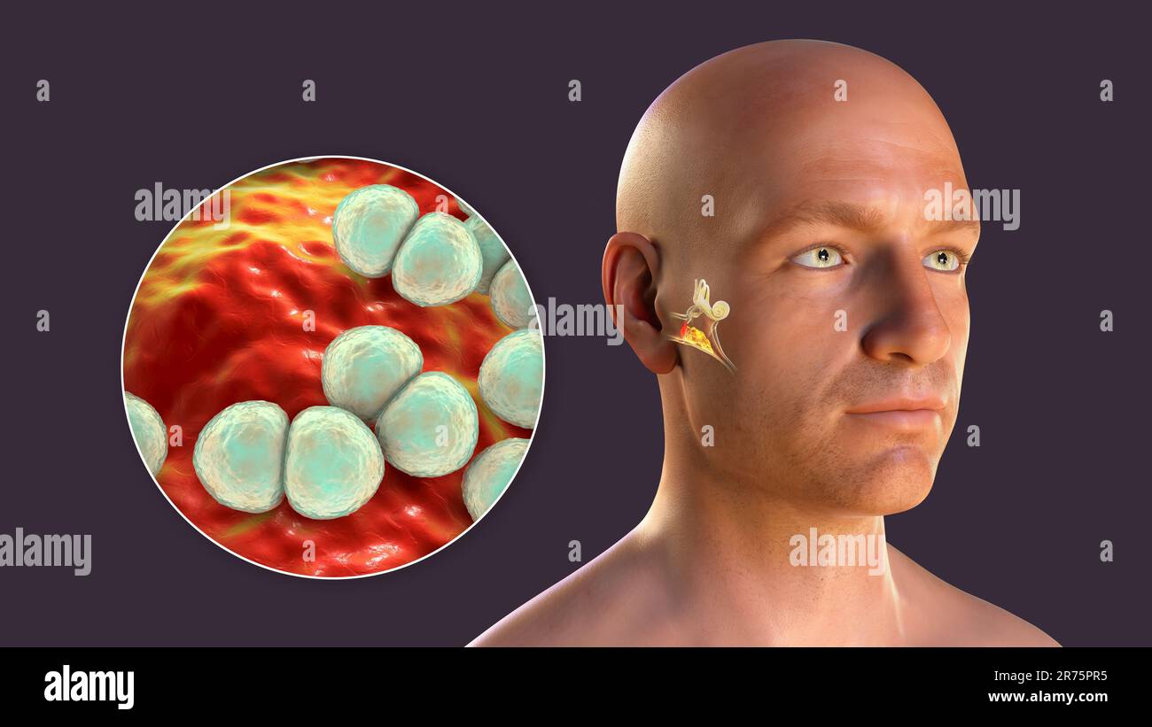 Otitis media Ohr Infektion durch Streptococcus pneumoniae Bakterien