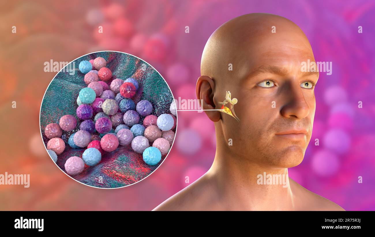 Antibiotika Streifen Im Ohr Wie Lange www.alamy.de