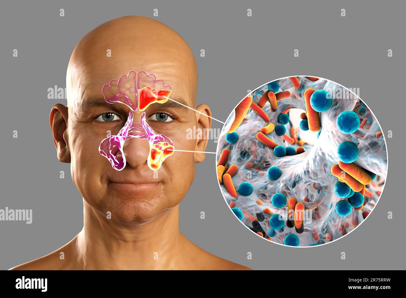 Sinusitis, Entzündung der Nasennebenhöhlen. Computerdarstellung der eitrigen Entzündung der Stirn- und Kieferhöhlen und Nahaufnahme Stockfoto