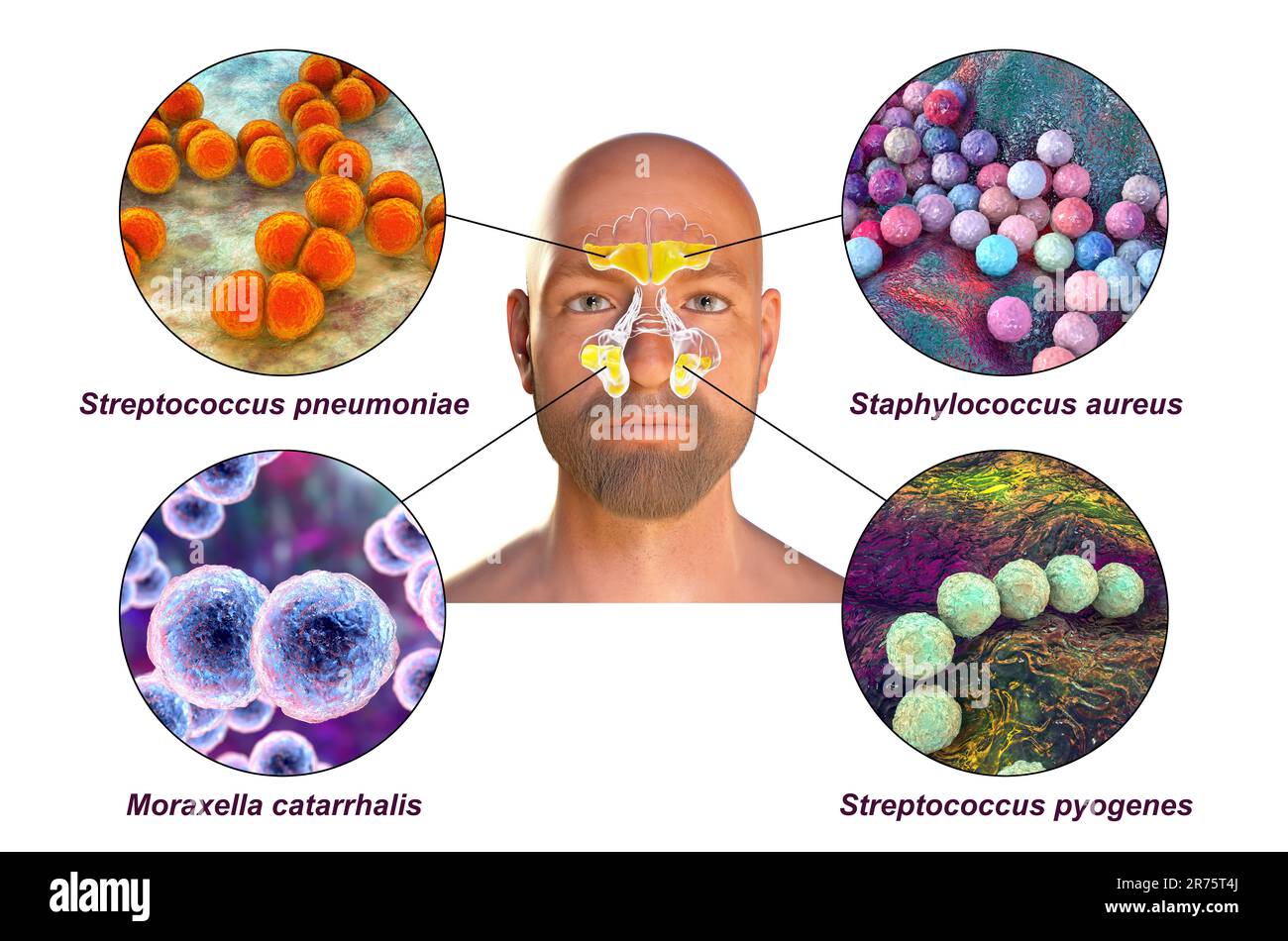 Rhinosinusitis bei einem Mann und Sinusitis-verursachende Bakterien. Streptococcus pneumoniae, Staphylococcus aureus, Moraxella catarrhalis und Streptococcus p Stockfoto