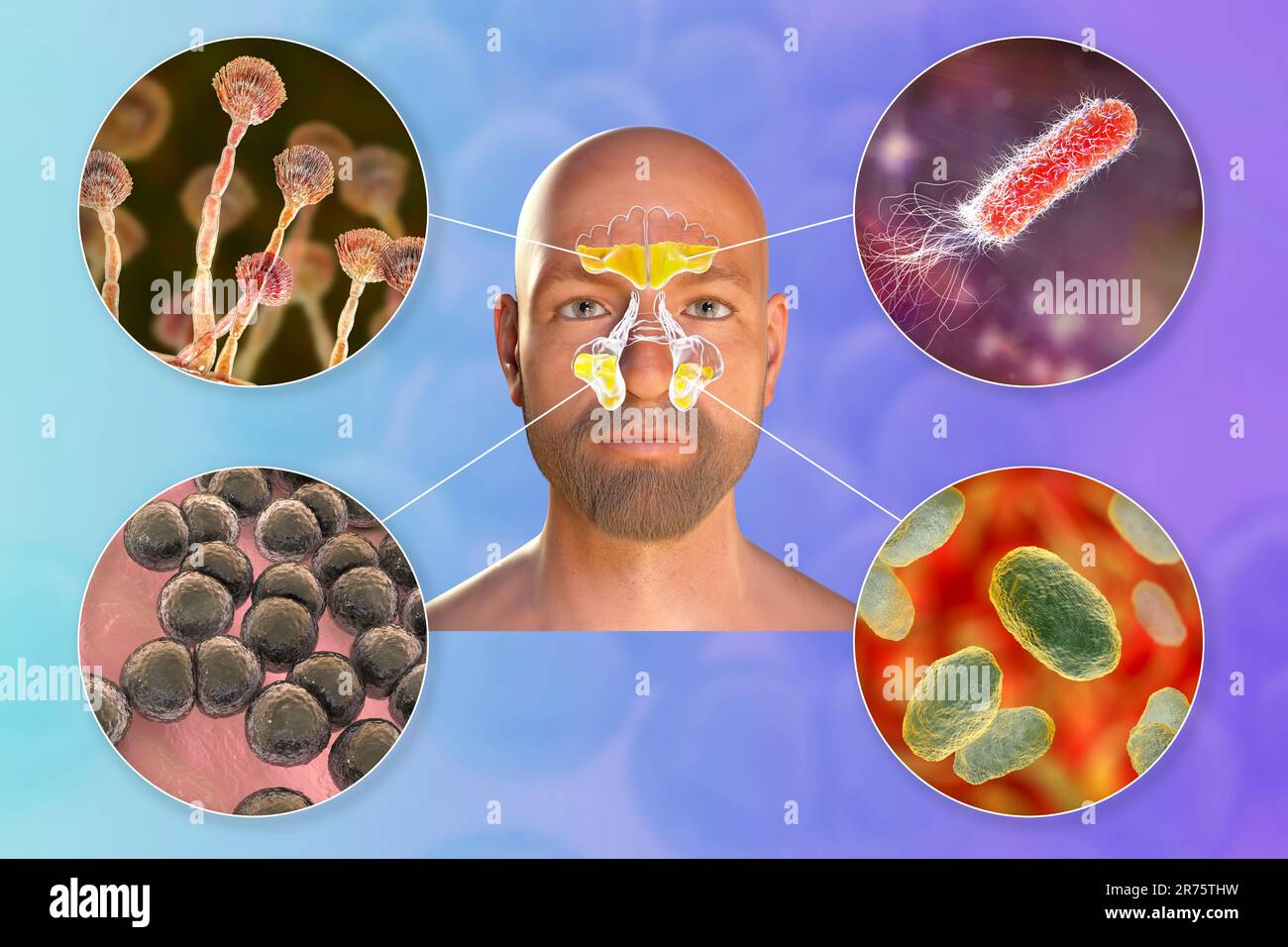Rhinosinusitis und Mikroorganismen, die Sinusitis, Aspergillus-Pilze, Bakterien wie Pseudomonas aeruginosa, Streptococcus pneumoniae und Haemophilus verursachen Stockfoto