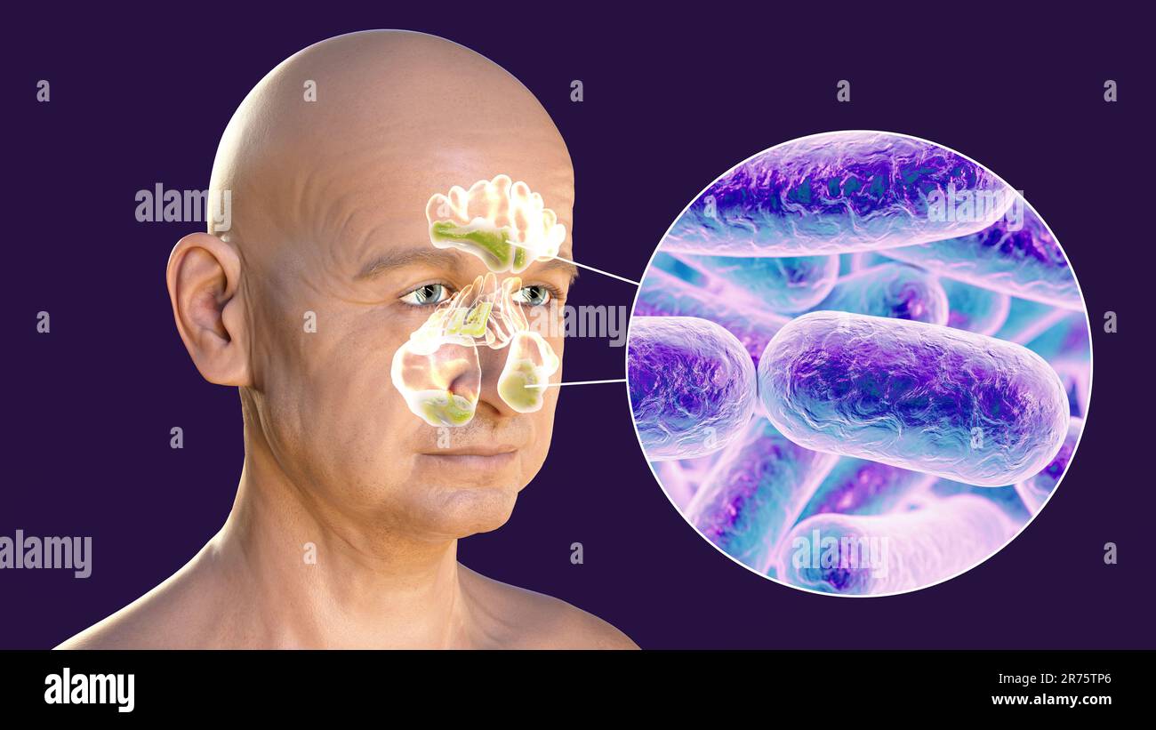 Sinusitis, Entzündung der Nasennebenhöhlen. Computerdarstellung der eitrigen Entzündung der Stirn- und Kieferhöhlen und Nahaufnahme Stockfoto