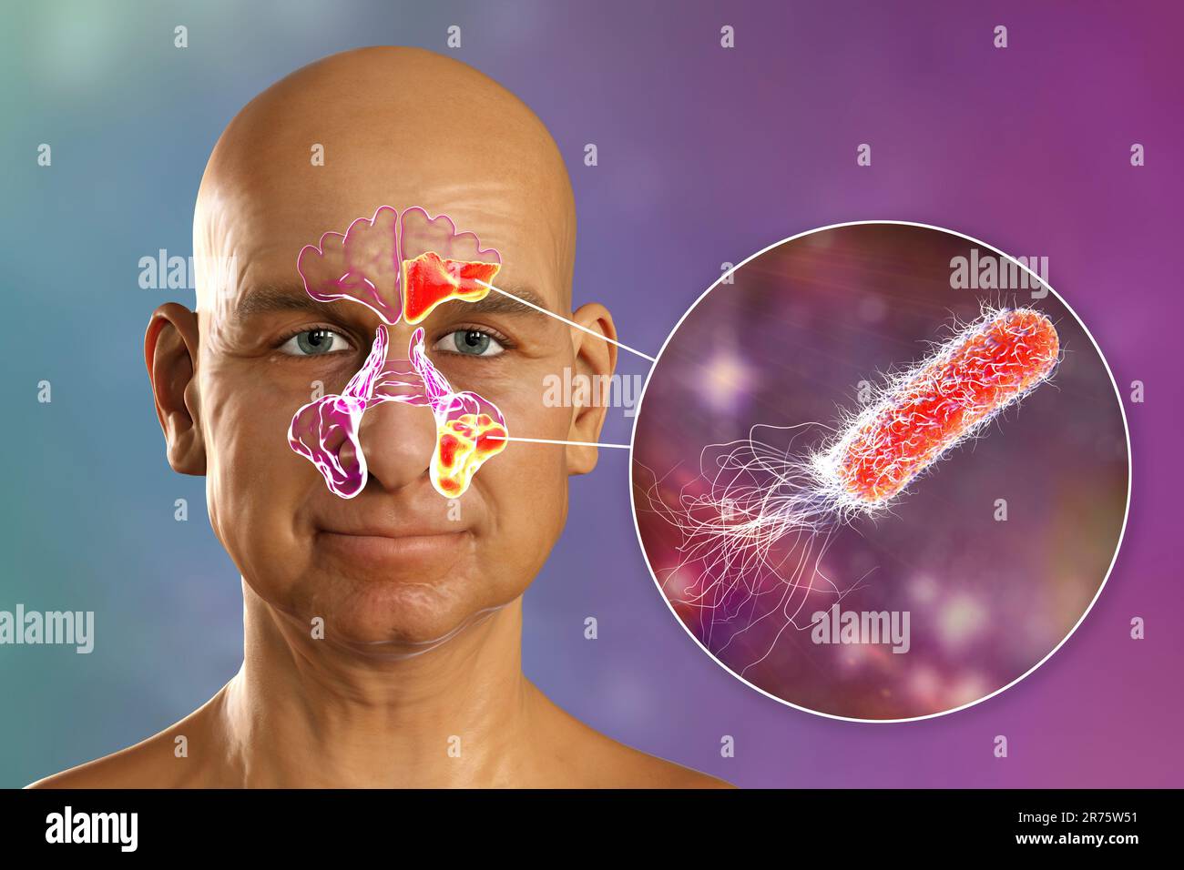 Pseudomonas aeruginosaBakterien als Ursache einer Sinusitis